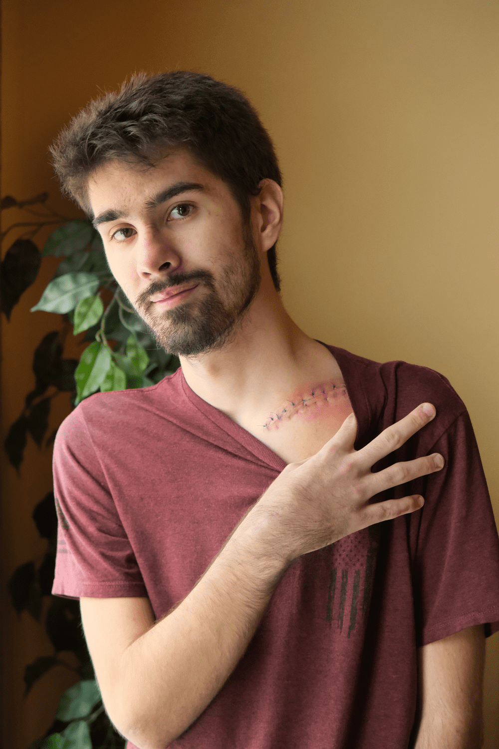 Rayce Hooper, a young white man with brown hair and beard, shows off a large scar under his collarbone.